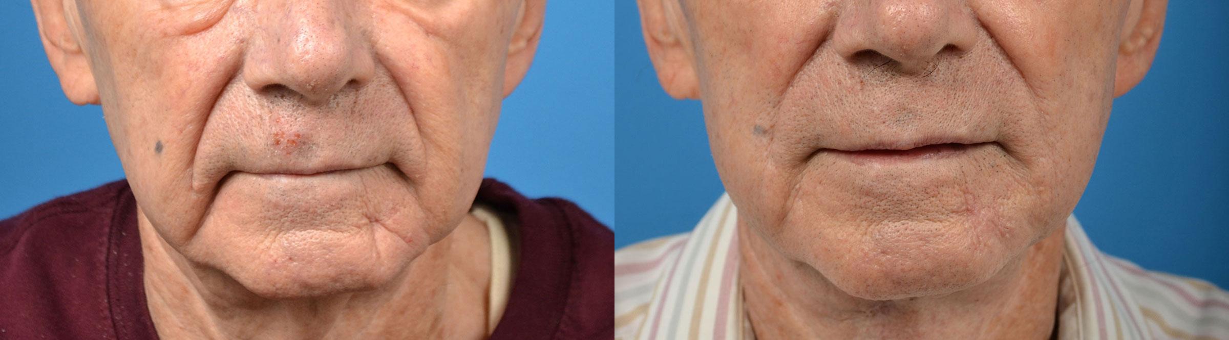 nasolabial-folds-photos-melbourne-fl-patient-57938